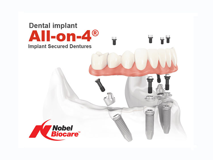 Dental implant all on 4
