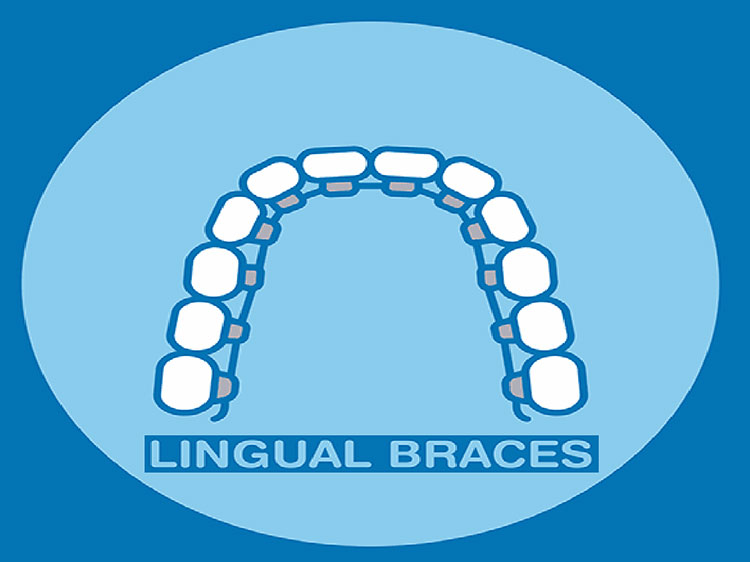 Lingual Braces