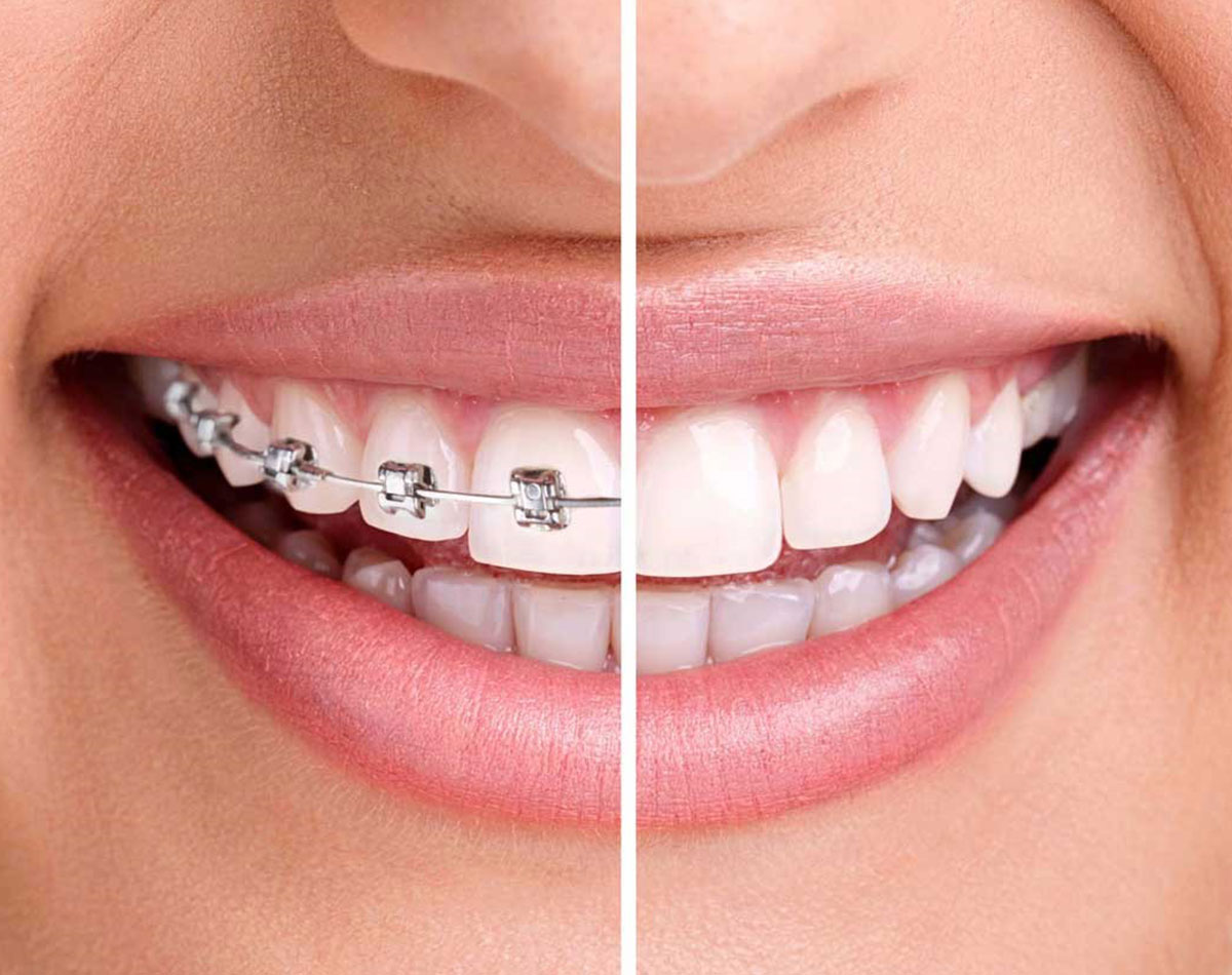 Braces-Aligners-Invisalign