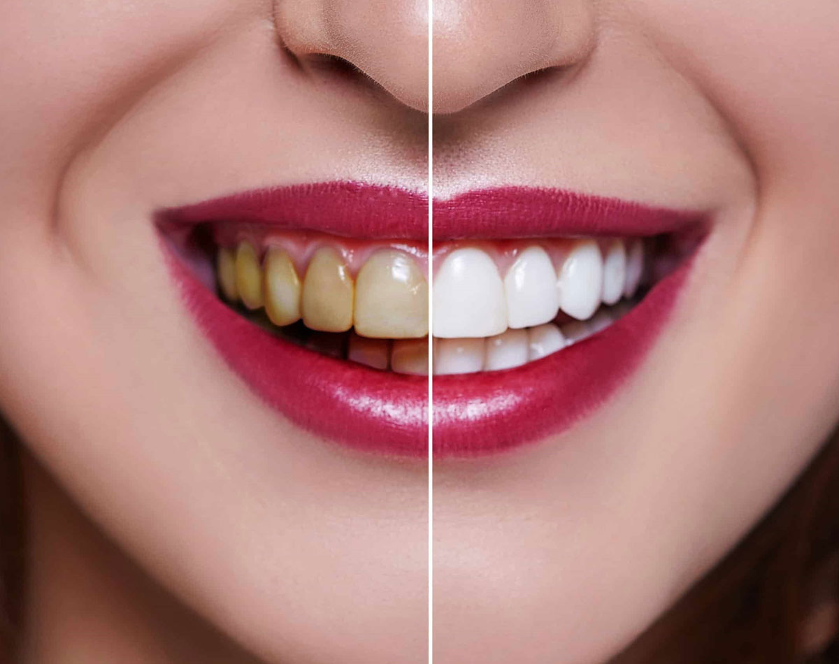 teeth whitning