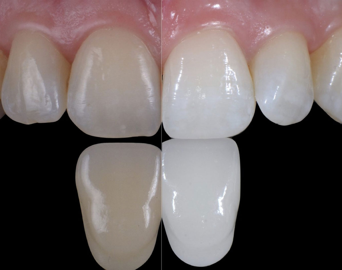 Teeth-whitening