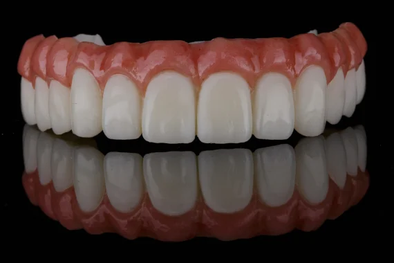 Benefits-Of-Full-Mouth-Restoration