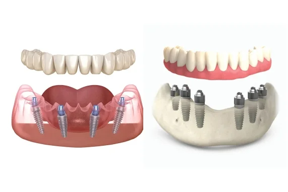 Full-Arch (Jaw) Teeth Replacement