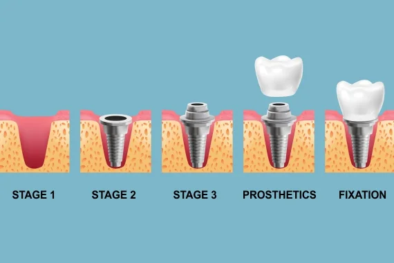 Procedure of Dental Implants