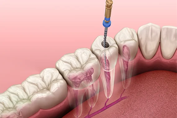 Root Canal Infection