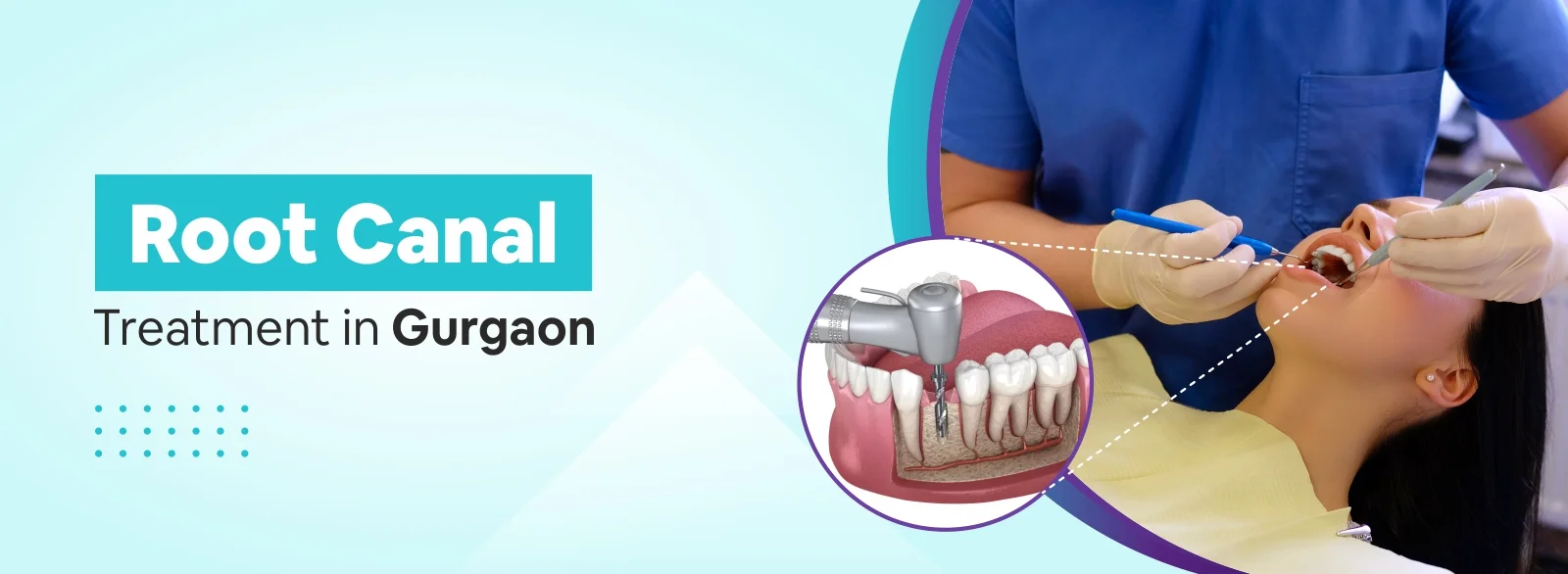 Root Canal Treatment in Gurgaon