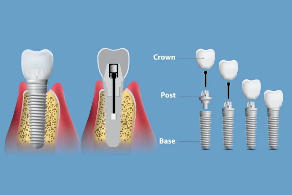 Types Of Dental Implants