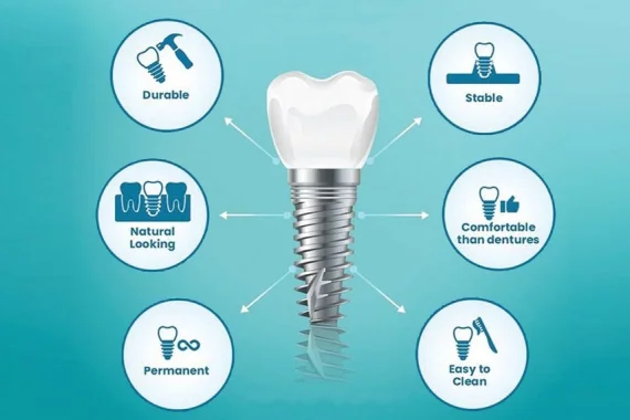 Benefits of Dental Implants
