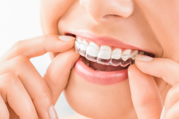 Clear aligner