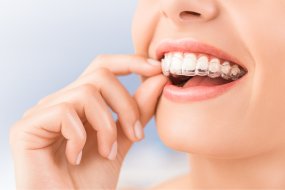 Procedures Of Invisalign Treatment