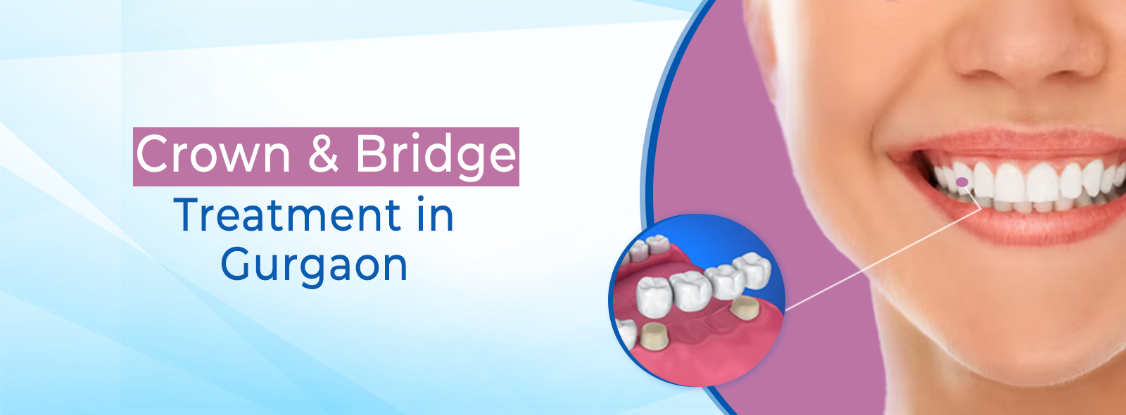 Crown & Bridge Treatment in Gurgaon
