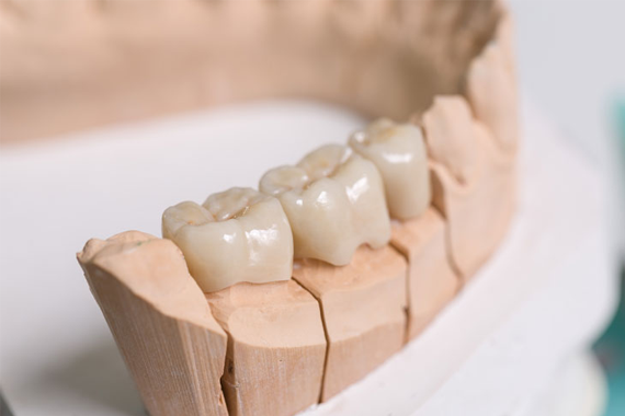 why-Opt-wor-crown-and-bridge-dental-treatment