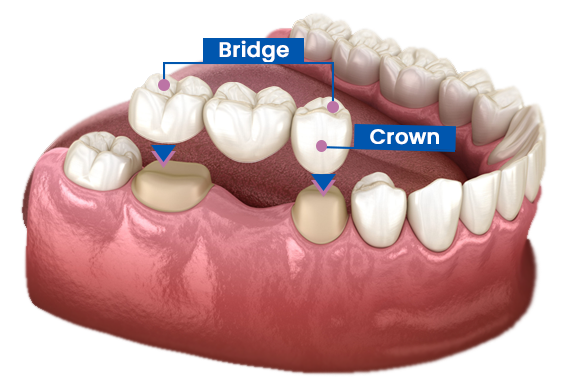 crown-and-bridge-dental