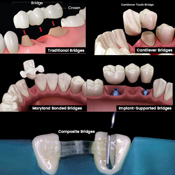 type-of-bridge