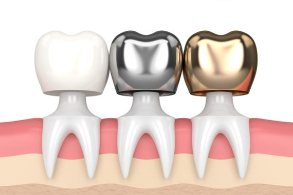 types-of-crowns