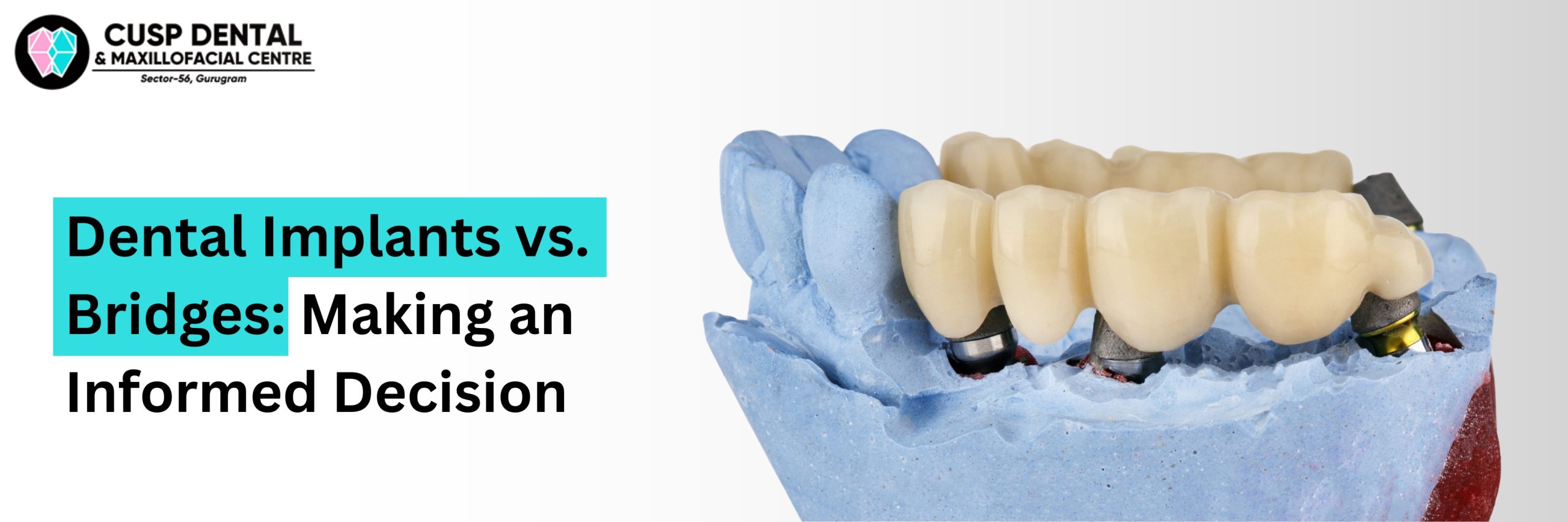 dental-implants-vs-bridges